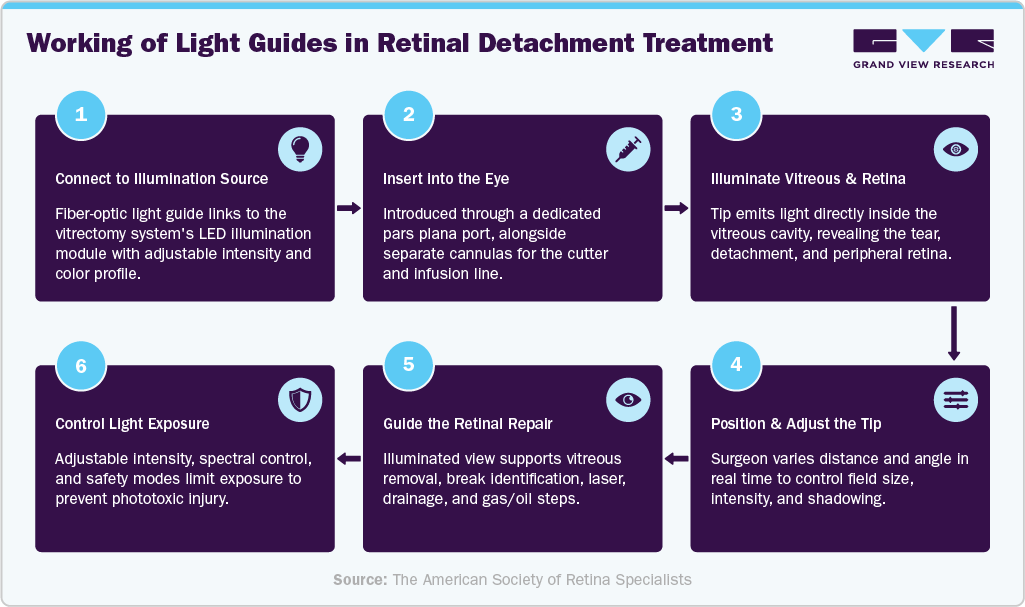 Working of Light Guides in Retinal Detachment Treatment